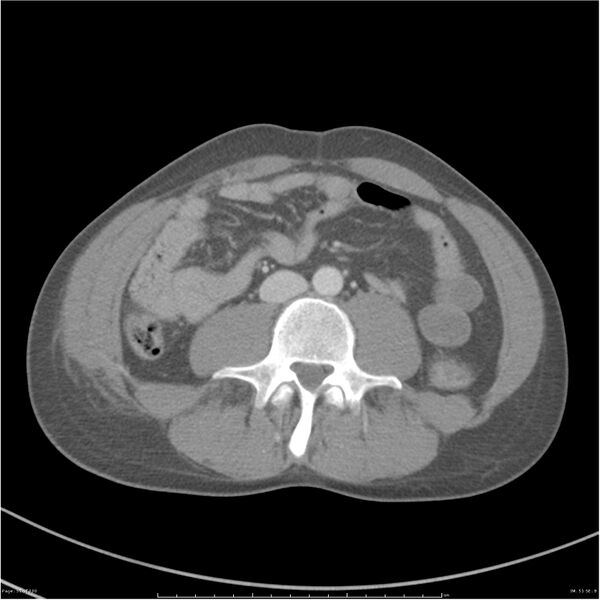 File:Chest and abdomen multi-trauma (Radiopaedia 26294-26426 bone window 51).jpg