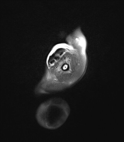 File:Chiari III malformation with occipital encephalocele (Radiopaedia 79446-92559 Axial FLAIR 3).jpg