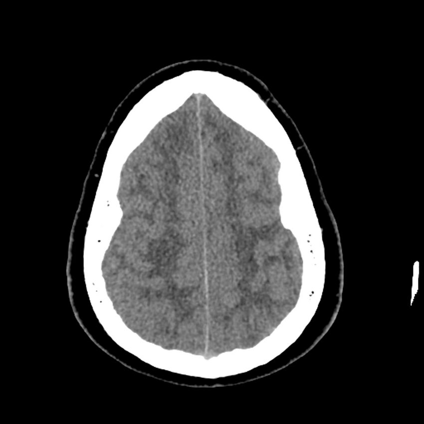 Chiasmatic-hypothalamic juvenile pilocytic astrocytoma (Radiopaedia 78533-91237 Axial non-contrast 46).jpg