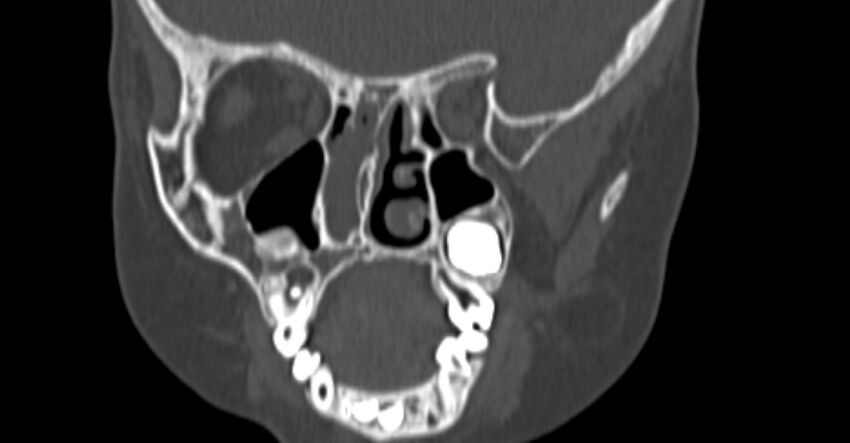 Choanal atresia (Radiopaedia 51295-56972 Coronal bone window 49).jpg