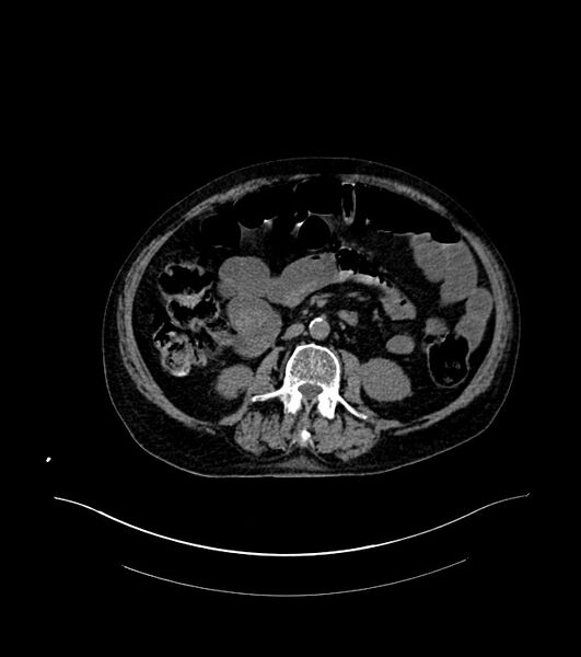 File:Cholangiocarcinoma with cerebral metastases (Radiopaedia 83519-98629 Axial non-contrast 56).jpg