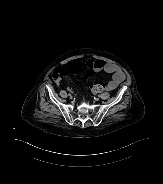 File:Cholangiocarcinoma with cerebral metastases (Radiopaedia 83519-98629 Axial non-contrast 96).jpg