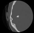 Cholesteatoma (Radiopaedia 20296-20217 bone window 39).jpg