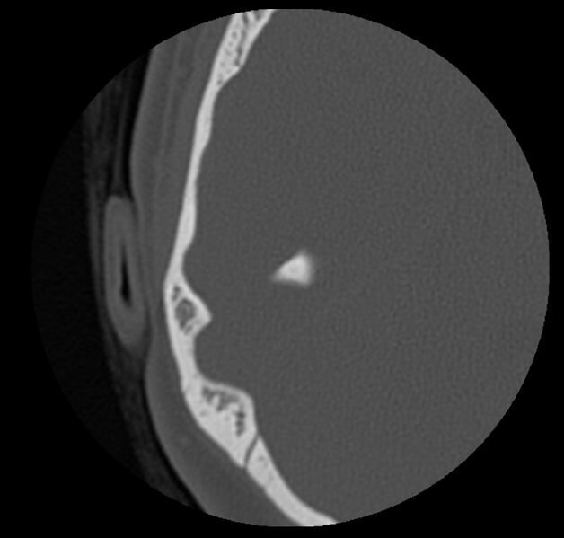 File:Cholesteatoma (Radiopaedia 20296-20217 bone window 39).jpg