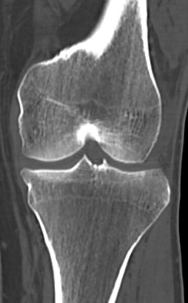 File:Chondrocalcinosis (Radiopaedia 82862-97173 Coronal bone window 44).jpg