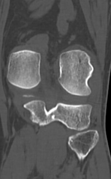 File:Chondrocalcinosis (Radiopaedia 82862-97173 Coronal bone window 58).jpg