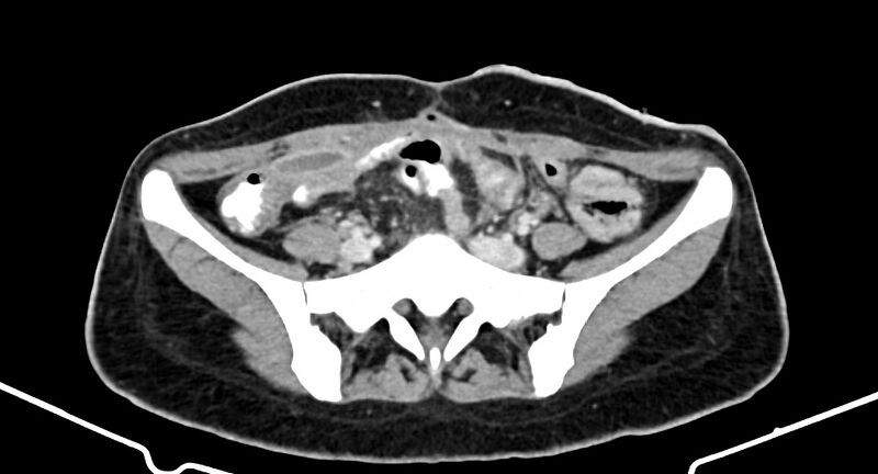 File:Choriocarcinoma liver metastases (Radiopaedia 74768-85766 A 150).jpg