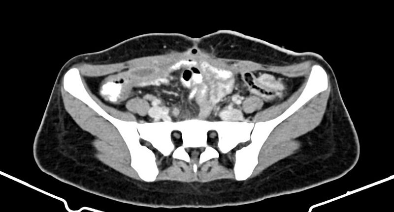 File:Choriocarcinoma liver metastases (Radiopaedia 74768-85766 A 154).jpg