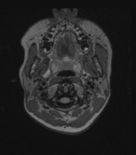 File:Choroid plexus carcinoma (Radiopaedia 91013-108553 Axial FLAIR C+ 57).jpg