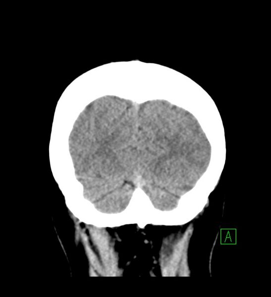 File:Choroid plexus xanthogranuloma (Radiopaedia 91271-108874 Coronal non-contrast 31).jpg