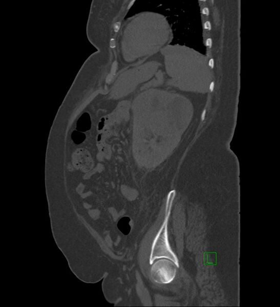 File:Chromophobe renal cell carcinoma (Radiopaedia 84239-99519 Sagittal bone window 26).jpg