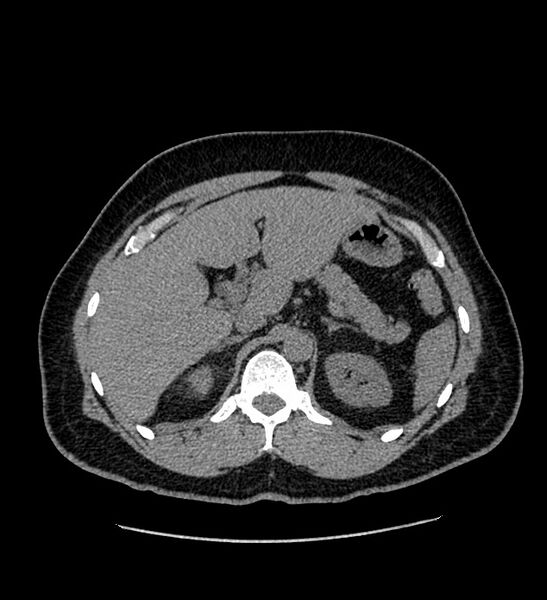 File:Chromophobe renal cell carcinoma (Radiopaedia 84337-99693 Axial non-contrast 35).jpg