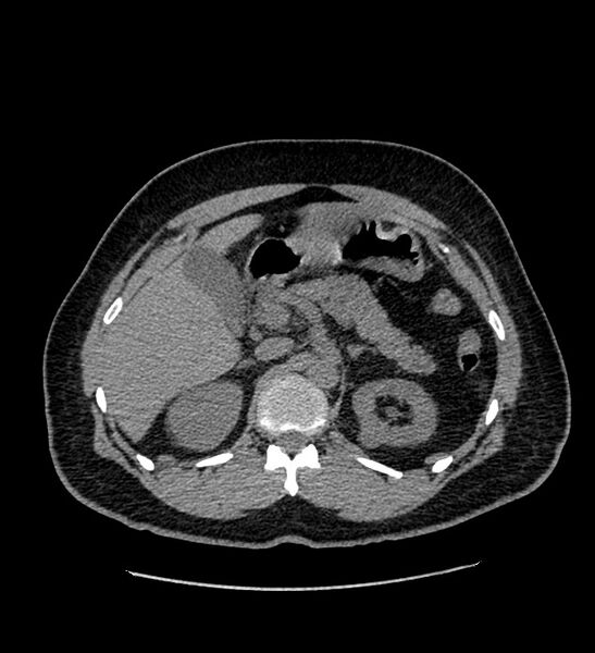 File:Chromophobe renal cell carcinoma (Radiopaedia 84337-99693 Axial non-contrast 40).jpg