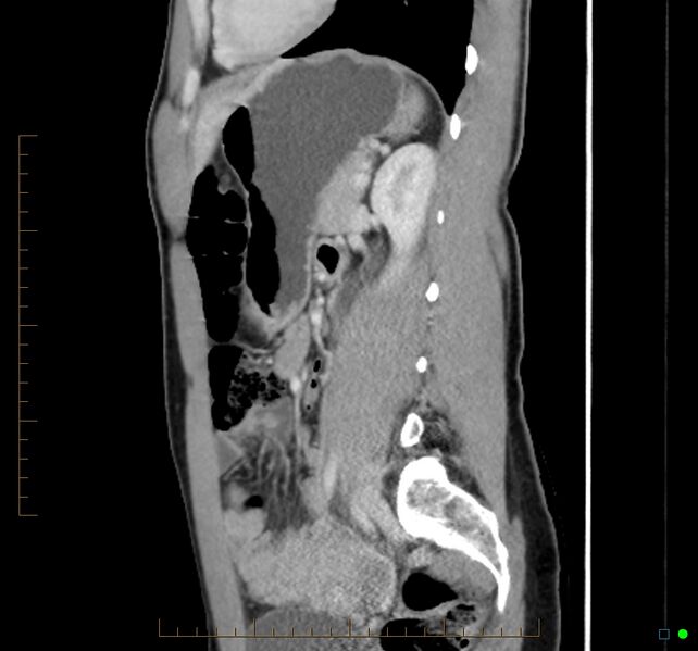 File:Chronic abscess due to "dropped" appendicoliths following appendectomy for perforated appendix (Radiopaedia 58805-66344 D 21).jpg