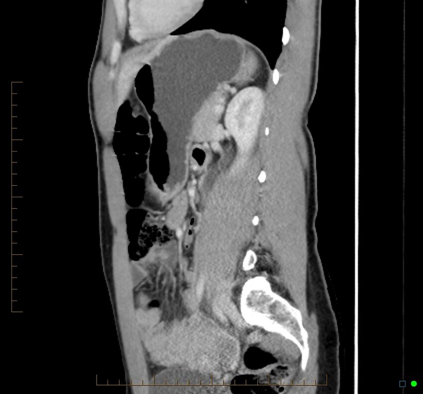 Chronic abscess due to "dropped" appendicoliths following appendectomy for perforated appendix (Radiopaedia 58805-66344 D 21).jpg