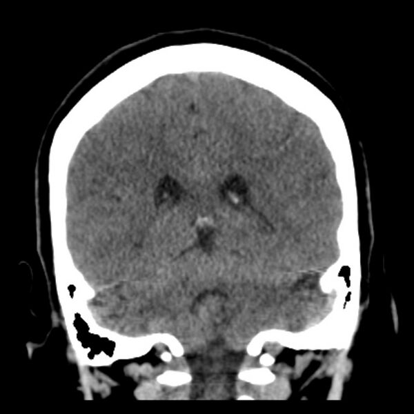 File:Chronic bilateral occipital lobe infarcts (Radiopaedia 31276-31996 Coronal non-contrast 33).jpg