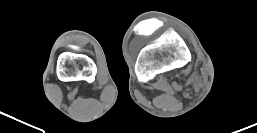 Chronic osteomyelitis (with sequestrum) (Radiopaedia 74813-85822 D 175).jpg