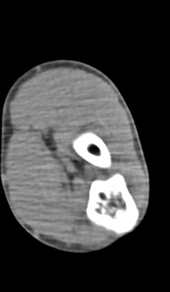 File:Chronic osteomyelitis of the distal humerus (Radiopaedia 78351-90971 Axial 209).jpg