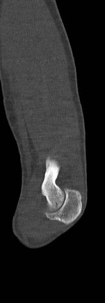 File:Chronic osteomyelitis of the distal humerus (Radiopaedia 78351-90971 Sagittal bone window 59).jpg