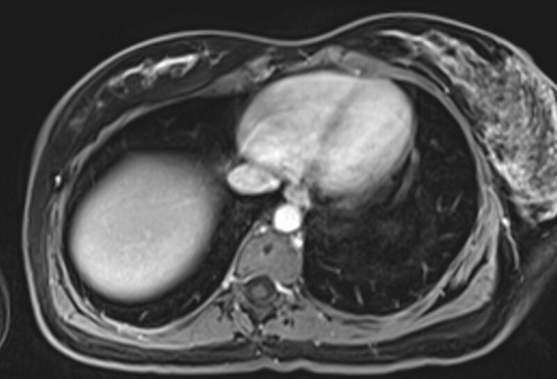 File:Chronic pancreatitis - pancreatic duct calculi (Radiopaedia 71818-82250 Axial T1 C+ fat sat 2).jpg