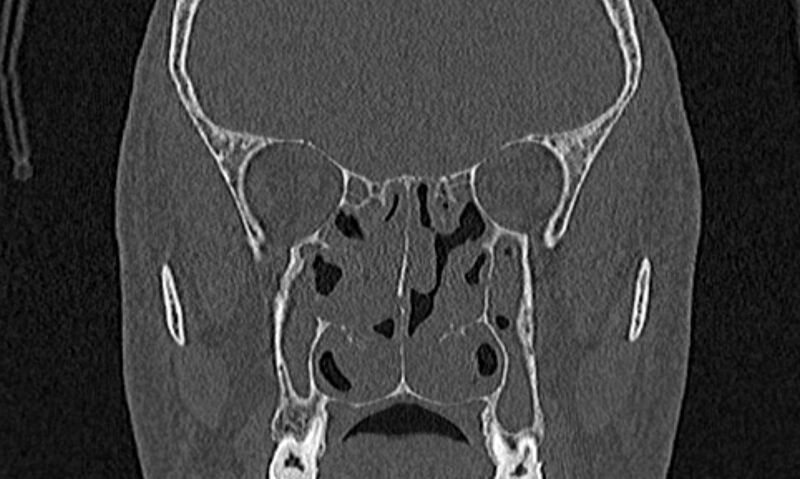 File:Chronic rhinosinusitis (Radiopaedia 65079-74075 Coronal bone window 47).jpg