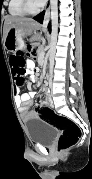 File:Chronic small bowel volvulus (Radiopaedia 75224-86322 C 72).jpg