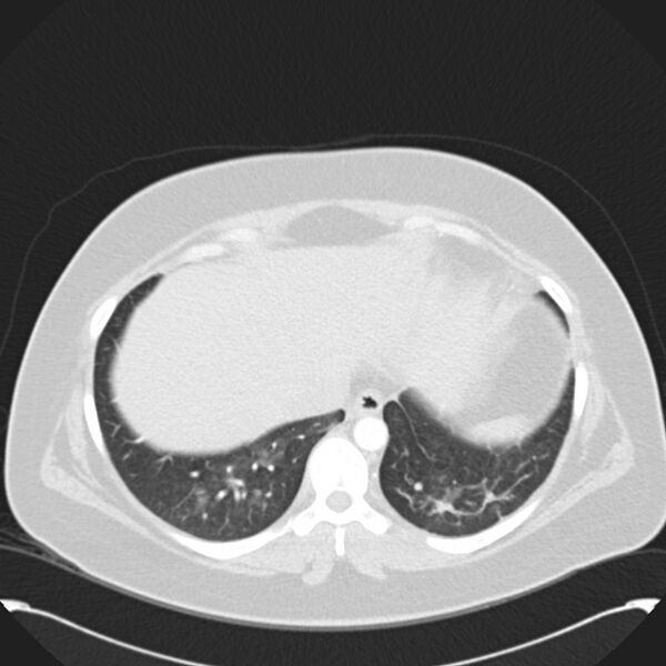 File:Chronic thromboembolic pulmonary hypertension (CTEPH) (Radiopaedia 74597-85531 Axial lung window 42).jpg
