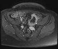 Class II Mullerian duct anomaly- unicornuate uterus with rudimentary horn and non-communicating cavity (Radiopaedia 39441-41755 Axial T1 fat sat 25).jpg