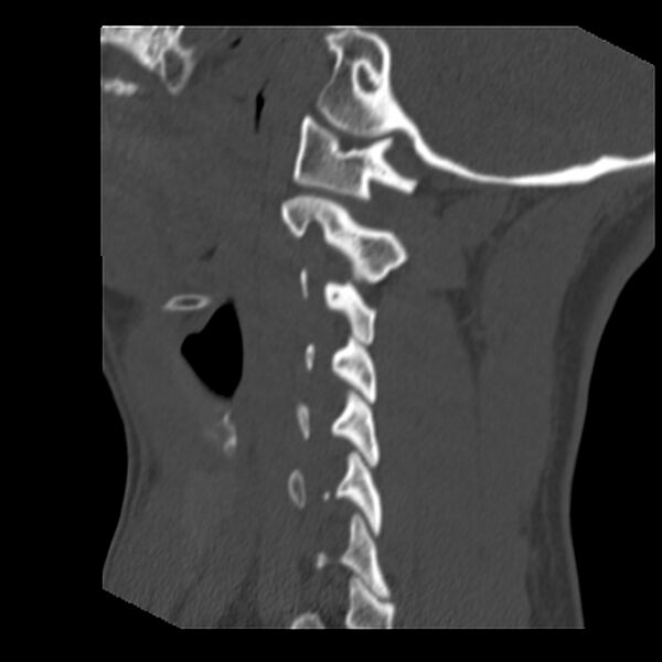 File:Clay-shoveler fracture (Radiopaedia 22568-22590 Sagittal bone window 10).jpg