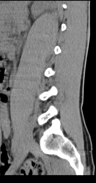 File:Clear cell meningoma - lumbar spine (Radiopaedia 60116-67691 A 13).png
