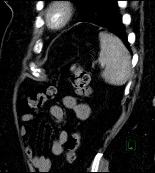 File:Clear cell renal cell carcinoma (Radiopaedia 85004-100537 D 12).jpg