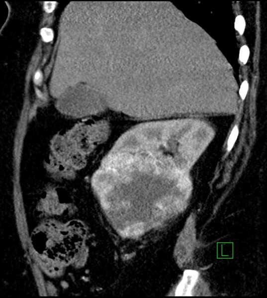 File:Clear cell renal cell carcinoma (Radiopaedia 85004-100537 D 47).jpg