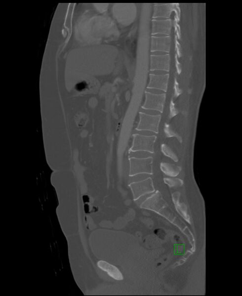 File:Clear cell renal cell carcinoma (Radiopaedia 85006-100539 Sagittal bone window 30).jpg