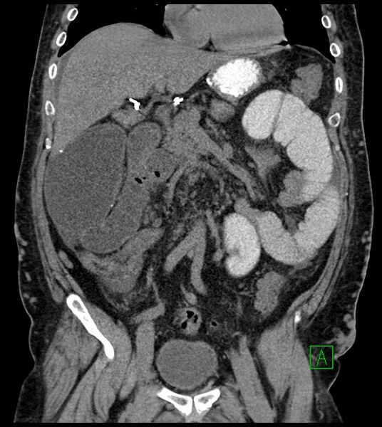 File:Closed-loop small bowel obstruction-internal hernia (Radiopaedia 78439-91096 Coronal non-contrast 46).jpg