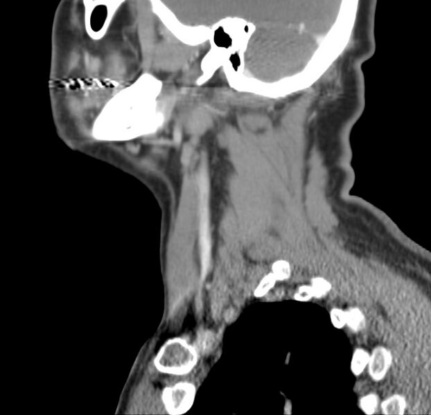 File:Colloid cyst of thyroid (Radiopaedia 22897-22923 Sagittal C+ delayed 17).jpg