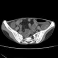 Colocolic fistula - Crohn disease (Radiopaedia 57063-63955 A 67).jpg