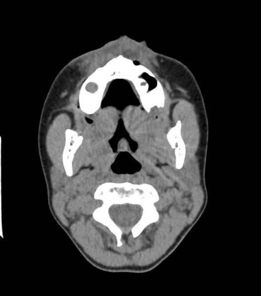 File:Nasoorbitoethmoid fracture (Radiopaedia 90044-107205 Axial non-contrast 92).jpg