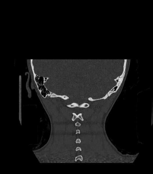 File:Nasoorbitoethmoid fracture (Radiopaedia 90044-107205 Coronal bone window 124).jpg