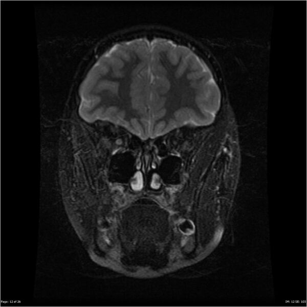 File:Neurofibromatosis type 1 (Radiopaedia 22541-22564 Coronal T2 fat sat 3).jpg
