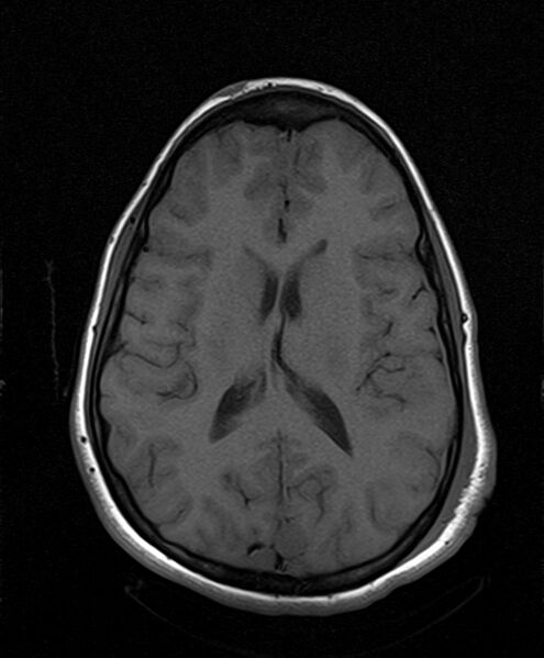 File:Neurofibromatosis type 2 (Radiopaedia 66211-75401 Axial T1 18).jpg