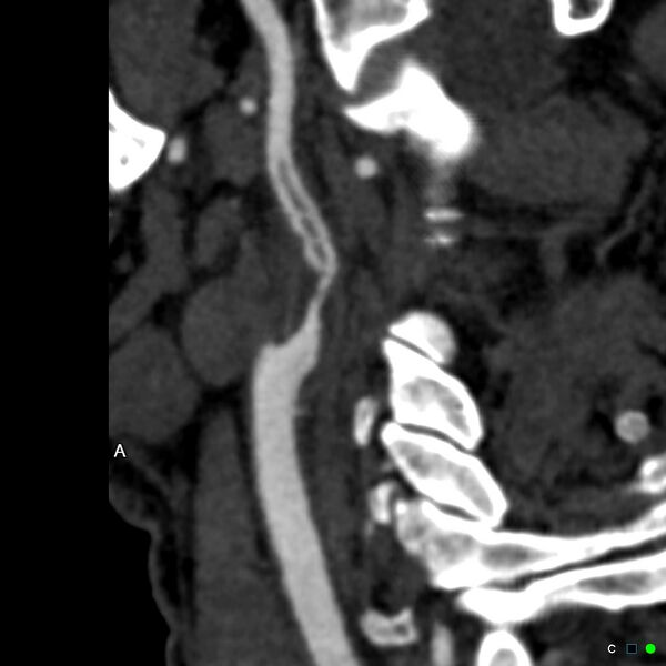 File:Non-occlusive intraluminal internal carotid artery thrombus (Radiopaedia 37751-39658 A 61).jpg