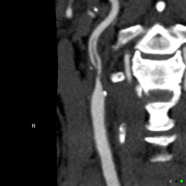 File:Non-occlusive intraluminal internal carotid artery thrombus (Radiopaedia 37751-39658 A 72).jpg