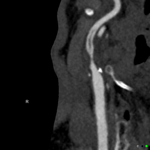 File:Non-occlusive intraluminal internal carotid artery thrombus (Radiopaedia 37751-39658 A 8).jpg