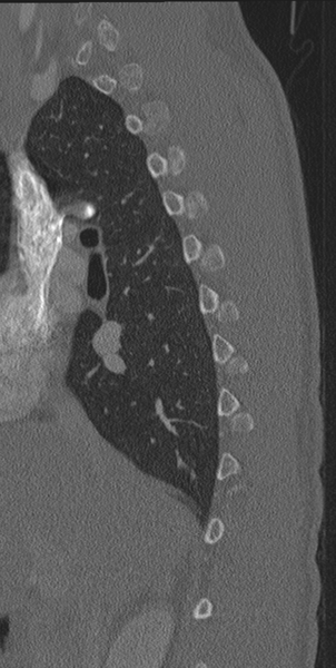 File:Normal CT thoracic spine (Radiopaedia 40181-42688 Sagittal bone window 53).png