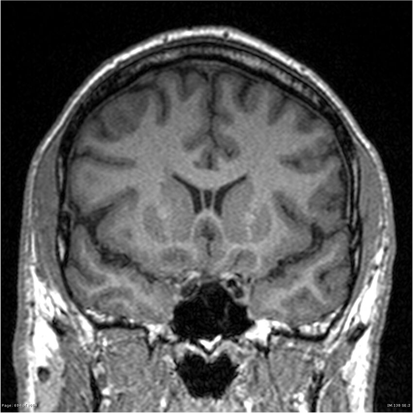 Normal brain MRI (non-focal epilepsy protocol) (Radiopaedia 38571-40700 Coronal T1 68).jpg