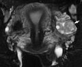 Normal corpus luteum on MRI (Radiopaedia 13818-13696 Coronal STIR 1).jpg