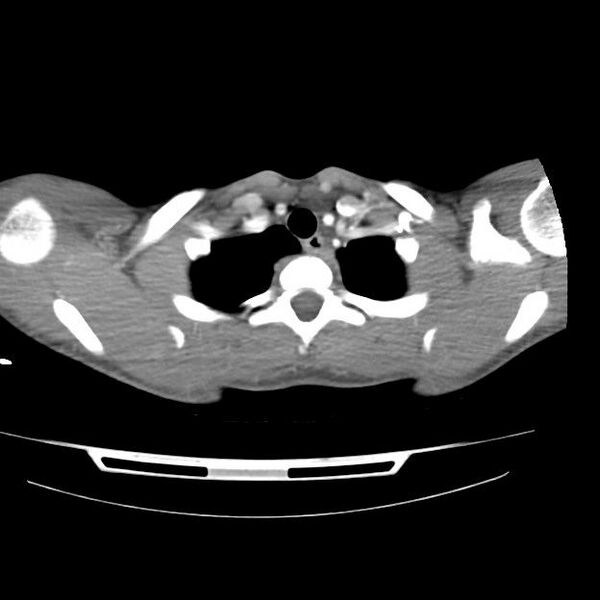 File:Normal dual-phase trauma CT chest,abdomen and pelvis (Radiopaedia 48092-52899 A 6).jpg