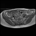 Normal female pelvis MRI (retroverted uterus) (Radiopaedia 61832-69933 Axial T1 9).jpg