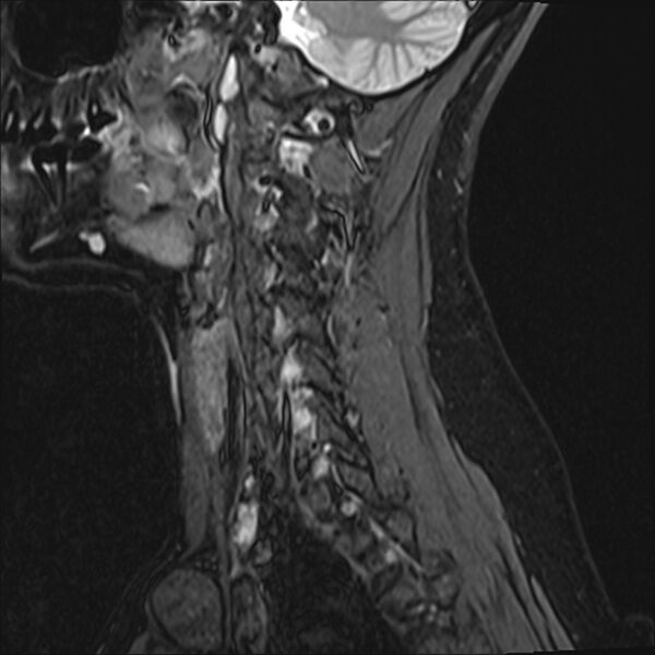 File:Normal trauma cervical spine MRI (Radiopaedia 32130-33071 Sagittal STIR 14).jpg