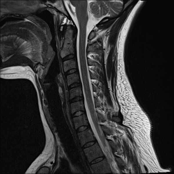 File:Normal trauma cervical spine MRI (Radiopaedia 32130-33071 Sagittal T2 7).jpg